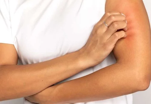 Świerzb – objawy, przyczyny, leczenie